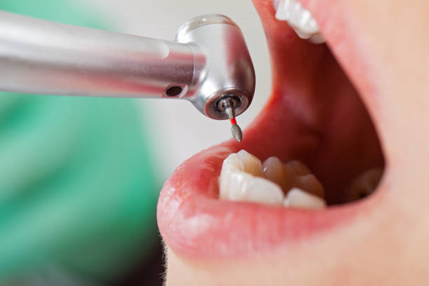 Best Broken or Cracked Tooth Emergency Dentist in Amelia, OH